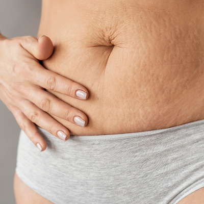 A Simple Yet Powerful 4 Step Ritual That Minimizes Postpartum Stretch Marks