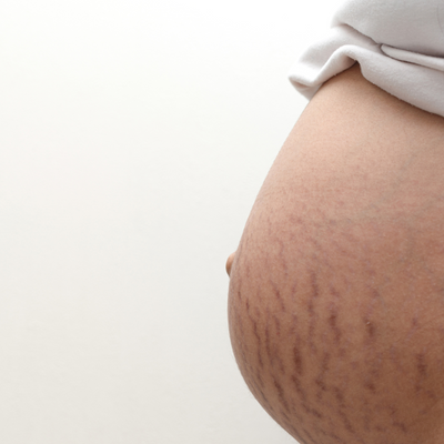 3 Tips To (Effectively) Prevent Stretch Marks During Pregnancy (Plus The 1 Early Sign of Impending Stretch Marks)