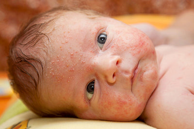 5 Common Infant Skin Conditions and Tips to Care for Them